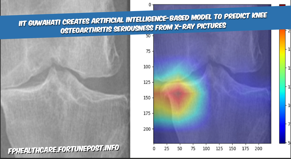 IIT Guwahati Creates Artificial Intelligence-based Model To Predict Knee Osteoarthritis Seriousness From X-ray Pictures