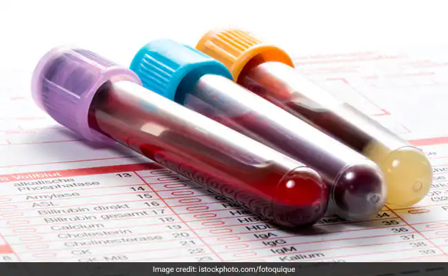 Liver Function Tests: Here’s A List Of Essential Tests That Can Help Monitor Your Liver’s Health